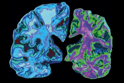 c0123811 alzheimer s disease spl 21